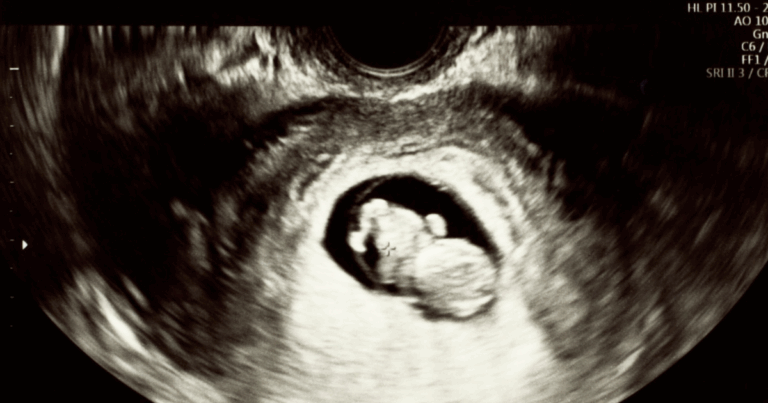 Ultrasound image of a fetus in the first trimester