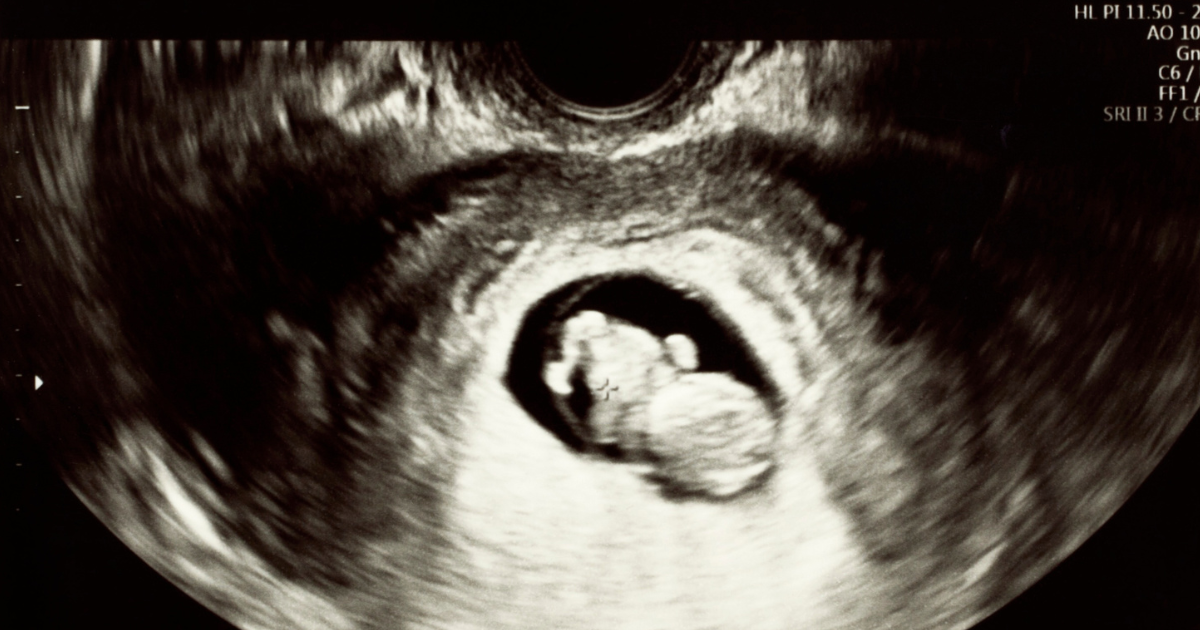 Ultrasound image of a fetus in the first trimester